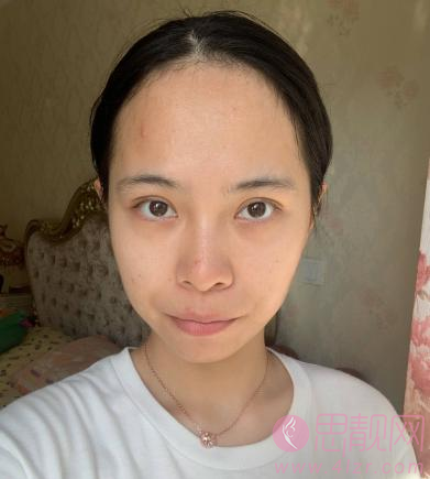 北京大学第三医院植发怎么样?发际线移植术后效果一览