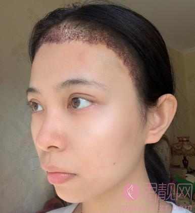 北京大学第三医院植发怎么样?发际线移植术后效果一览
