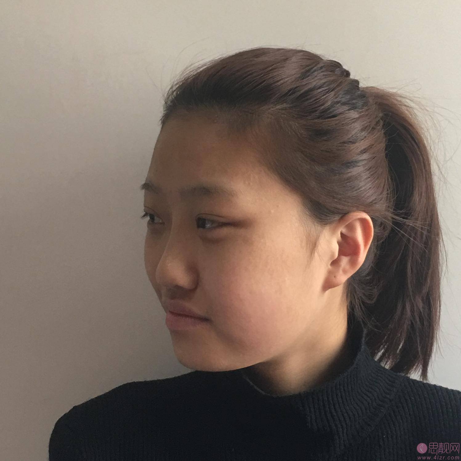 北京加减美口碑怎么样?附医院介绍及埋线提升真人案例分享