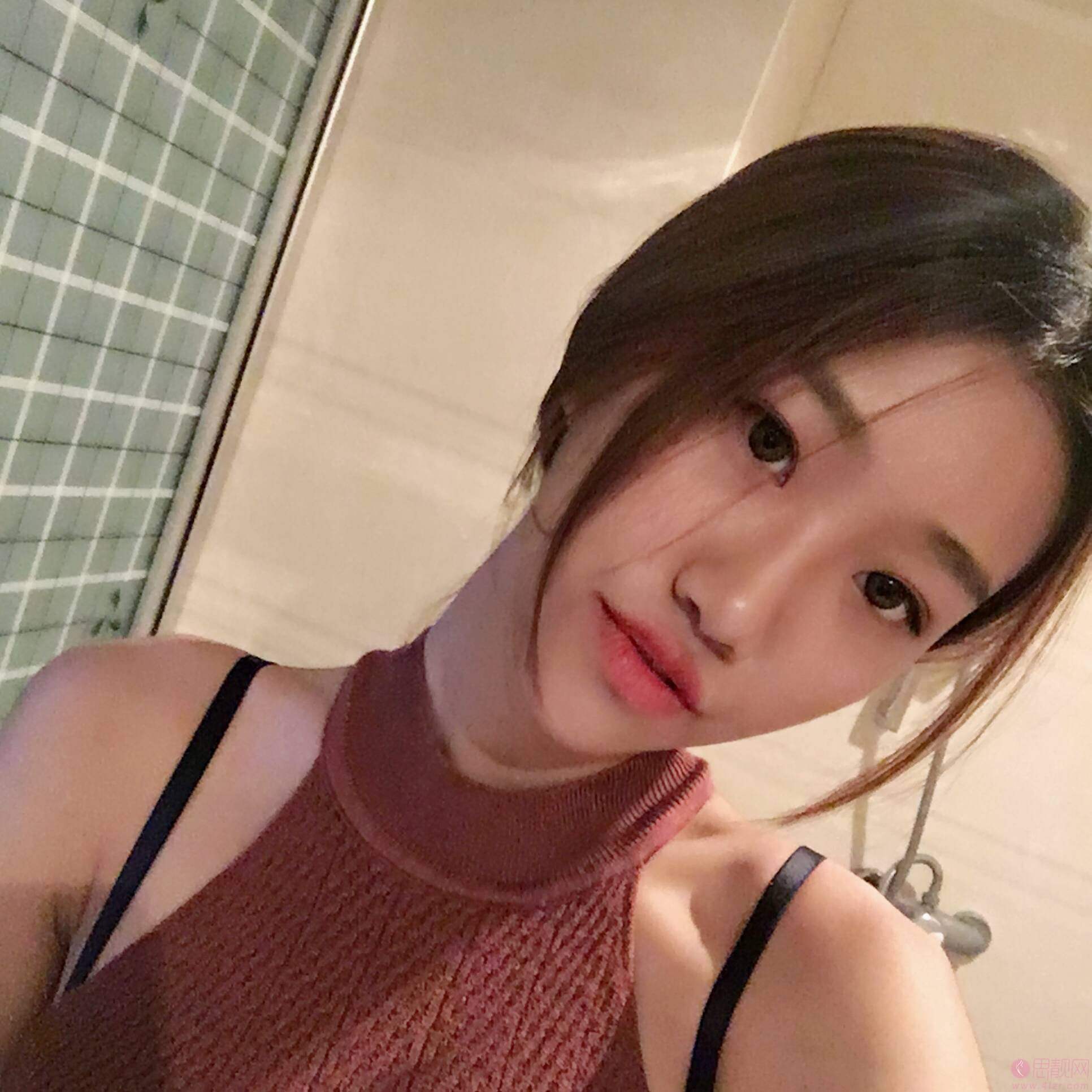北京加减美口碑怎么样?附医院介绍及埋线提升真人案例分享