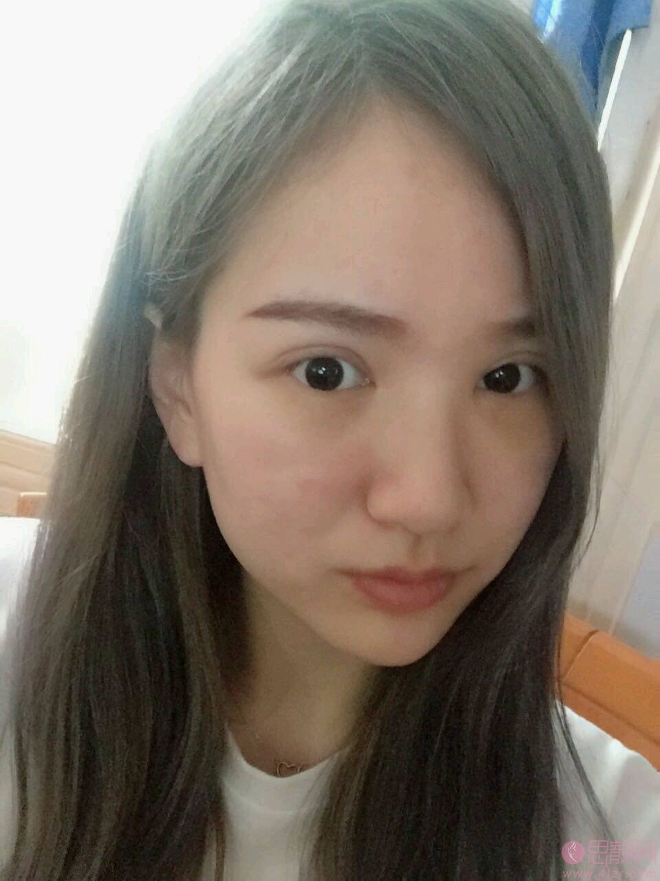 北医三院去眼袋效果怎么样?术后真人效果一览+2021价格表发布