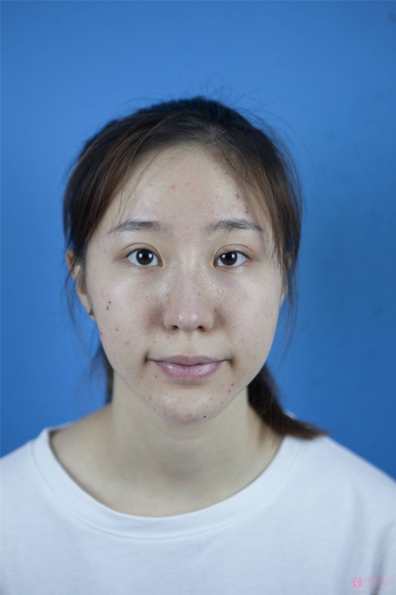 广州美莱2021整形价格表全新上线+光子嫩肤术后真人案例分享