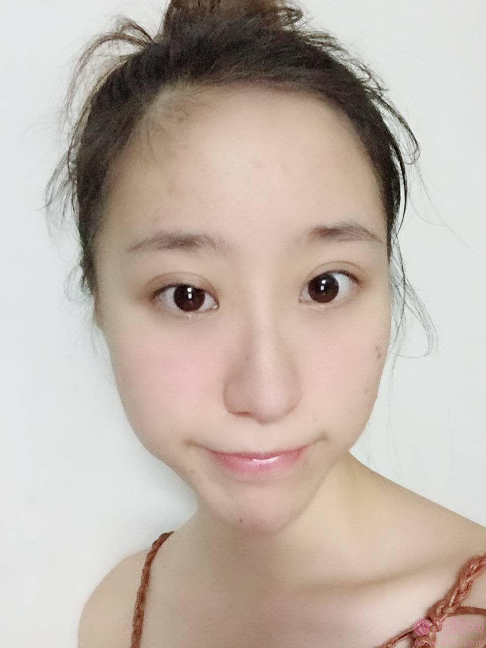 广州美莱2021整形价格表全新上线+光子嫩肤术后真人案例分享