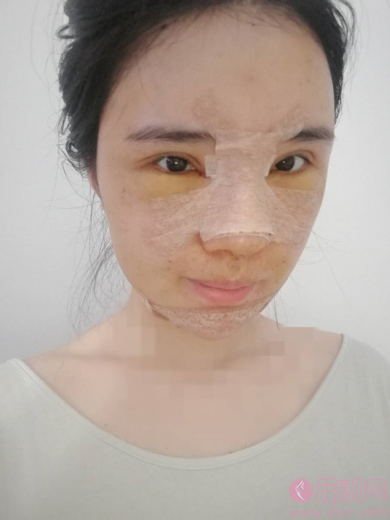 深圳美莱梁晓健鼻子做的好不好?真实案例图及2021价格表明细一览