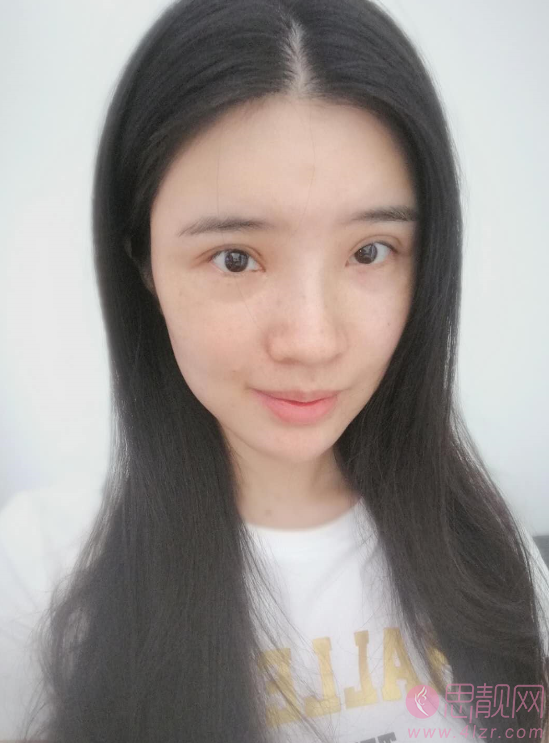 深圳美莱梁晓健鼻子做的好不好?真实案例图及2021价格表明细一览