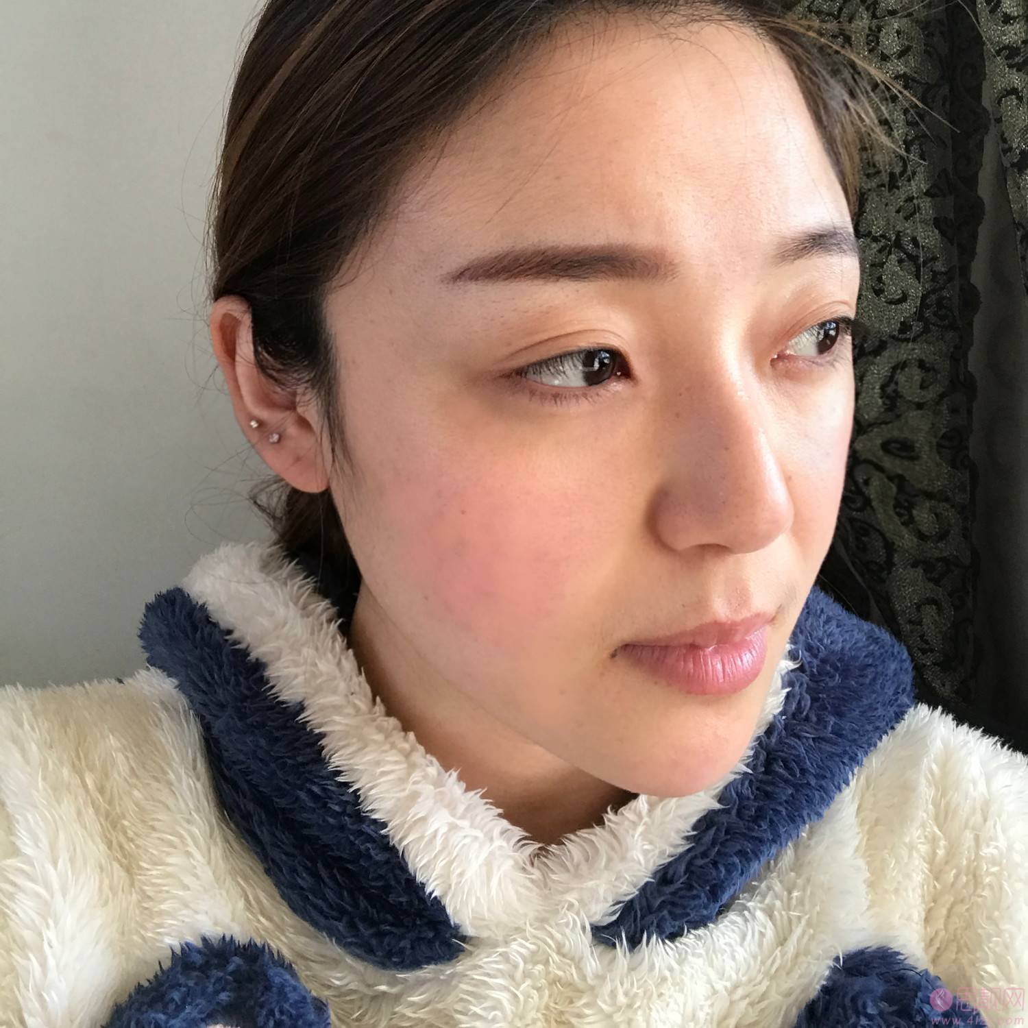 四川华美紫馨医学美容医院靠谱吗？附医院介绍及自体脂肪填充案例
