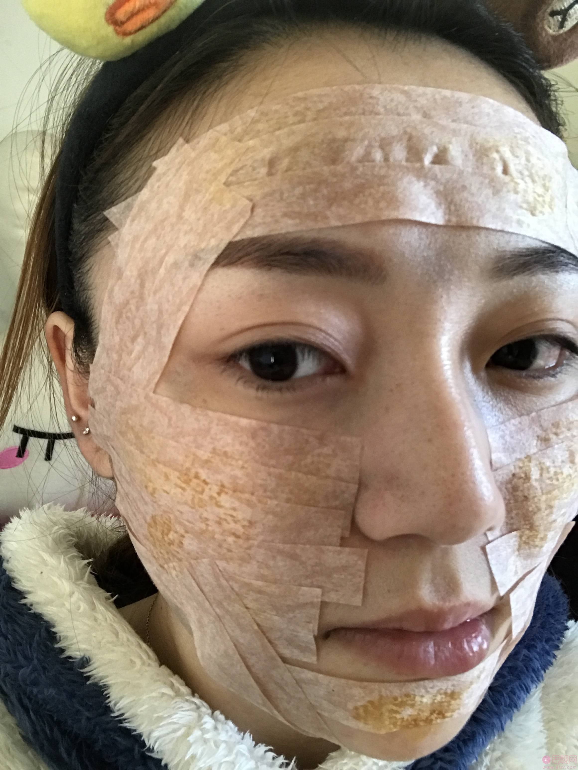 四川华美紫馨医学美容医院靠谱吗？附医院介绍及自体脂肪填充案例