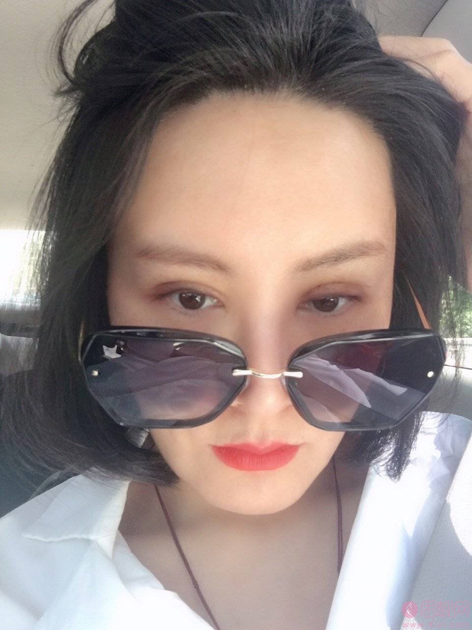 长沙爱思特郑颖平修复双眼皮怎么样?附案例及2021价格表一览