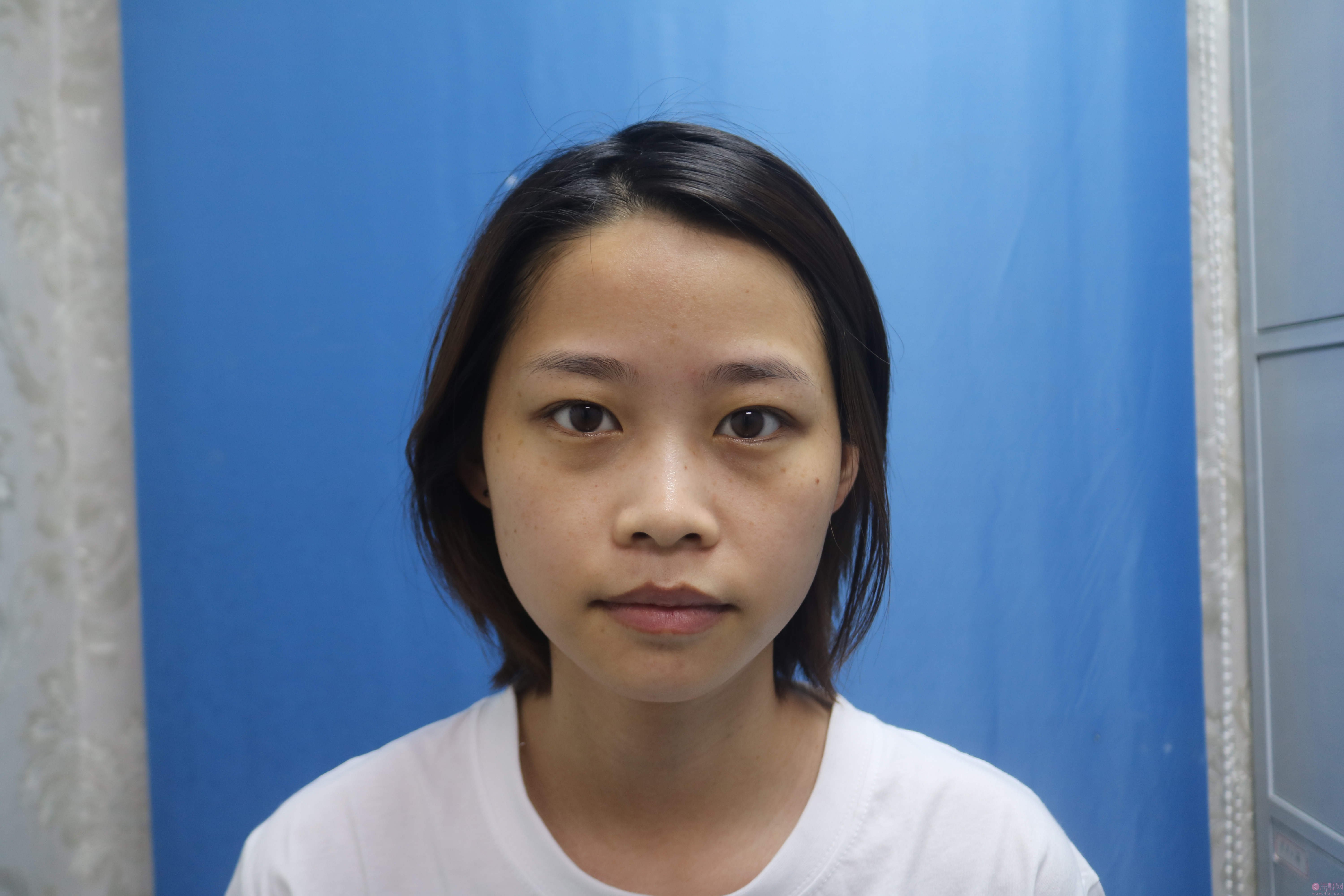 西南医院去眼袋怎么样?附术后真人案例展示