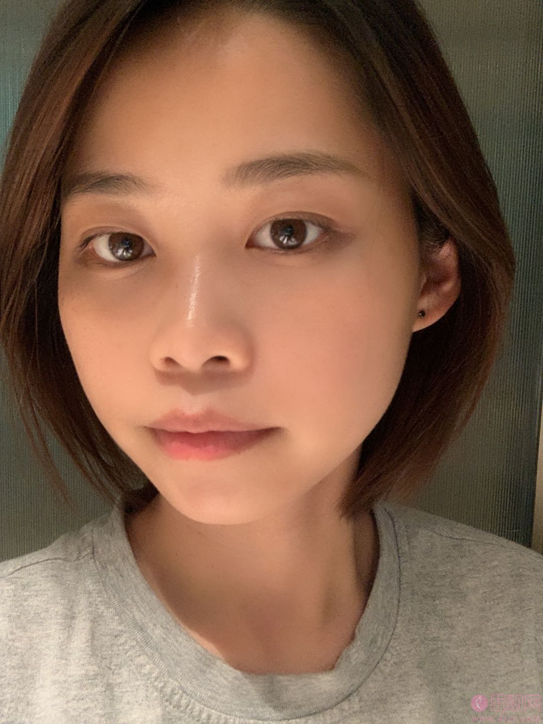西南医院去眼袋怎么样?附术后真人案例展示