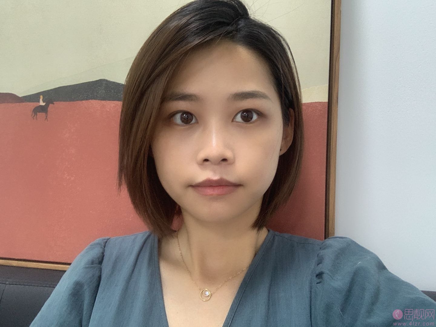 西南医院去眼袋怎么样?附术后真人案例展示