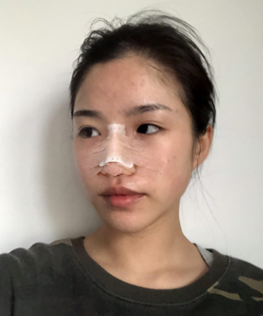 杭州时光胡斌隆鼻技术如何?真人案例+最新价格表一览