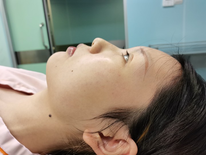 成都艺星陈远琨做的鼻子怎么样？附隆鼻真人分享+2021价格表曝光