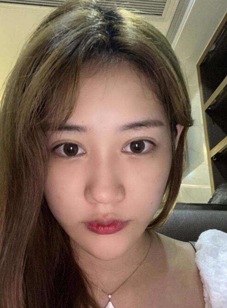 郑州东方整形美容医院隆鼻好不好？附隆鼻案例+2021价格表上线
