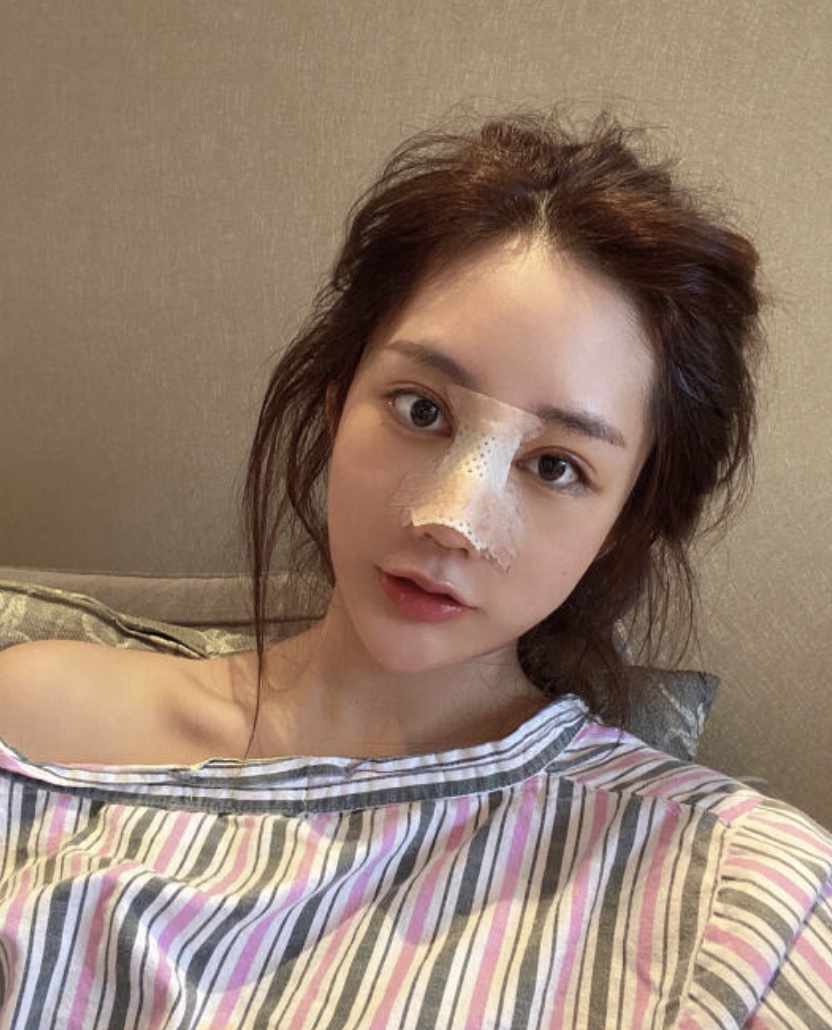 郑州东方整形美容医院隆鼻好不好？附隆鼻案例+2021价格表上线