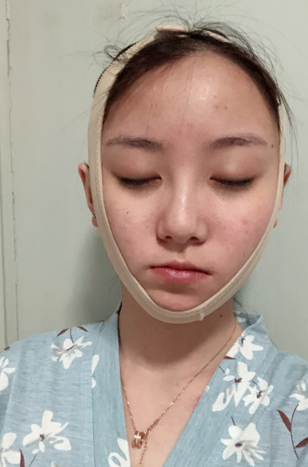 姜民范颧骨手术怎么样?附案例及2021价格表曝光 姜民范颧骨手术怎么样?附案例及2021价格表曝光