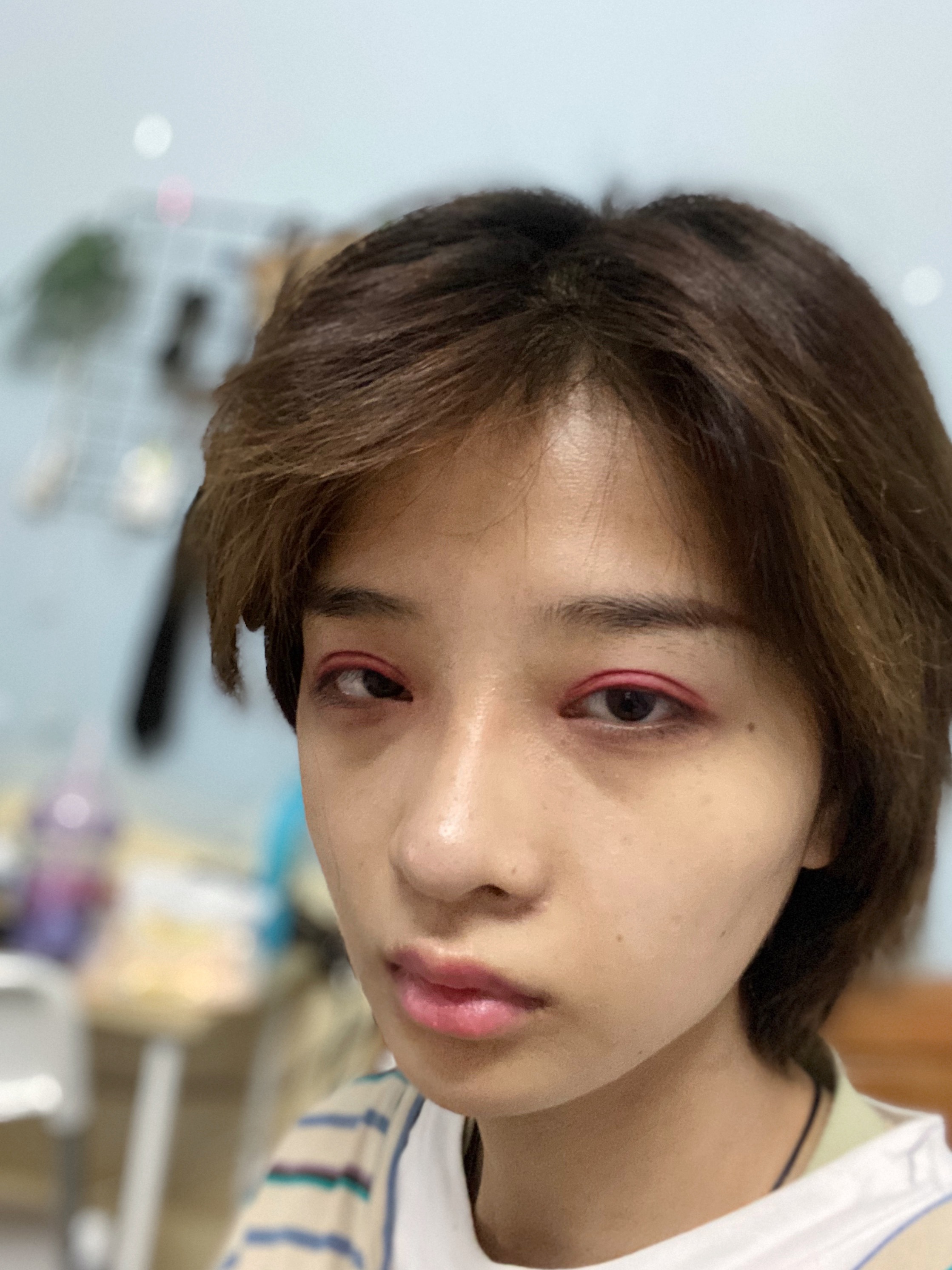 重庆星荣整形外科医院吕巍做双眼皮怎么样？附医生信息介绍+双眼皮案例分享