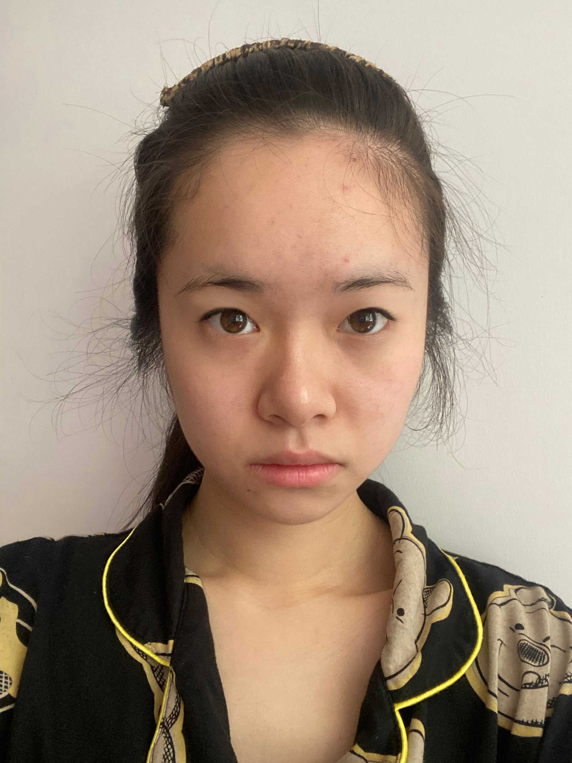 重庆当代整形美容医院双眼皮做得怎样？附双眼皮案例