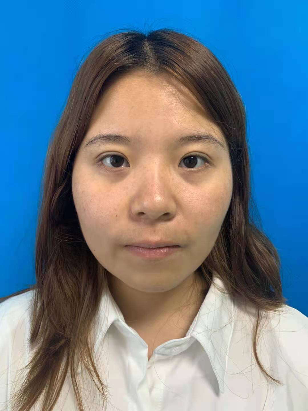 郑州大学第二附属医院整形科隆鼻怎么样？附隆鼻案例及2021价格表