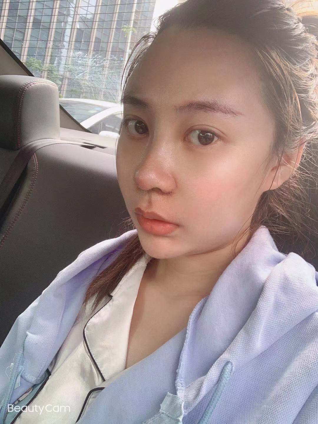 隆鼻修复真人前后效果对比图一览
