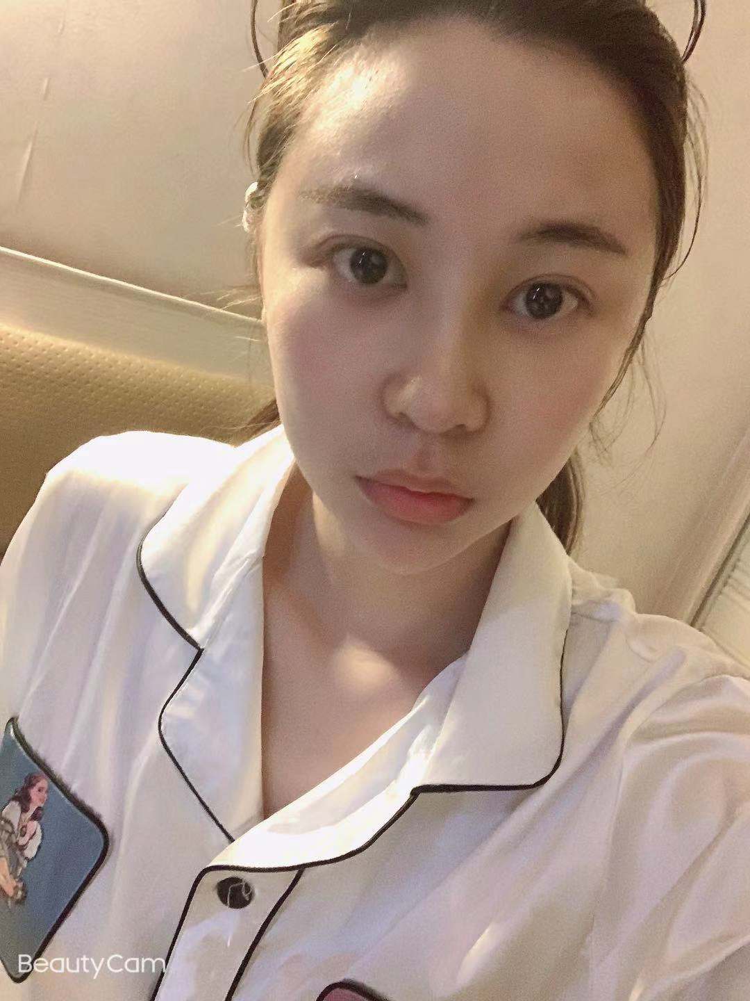 隆鼻修复真人前后效果对比图一览
