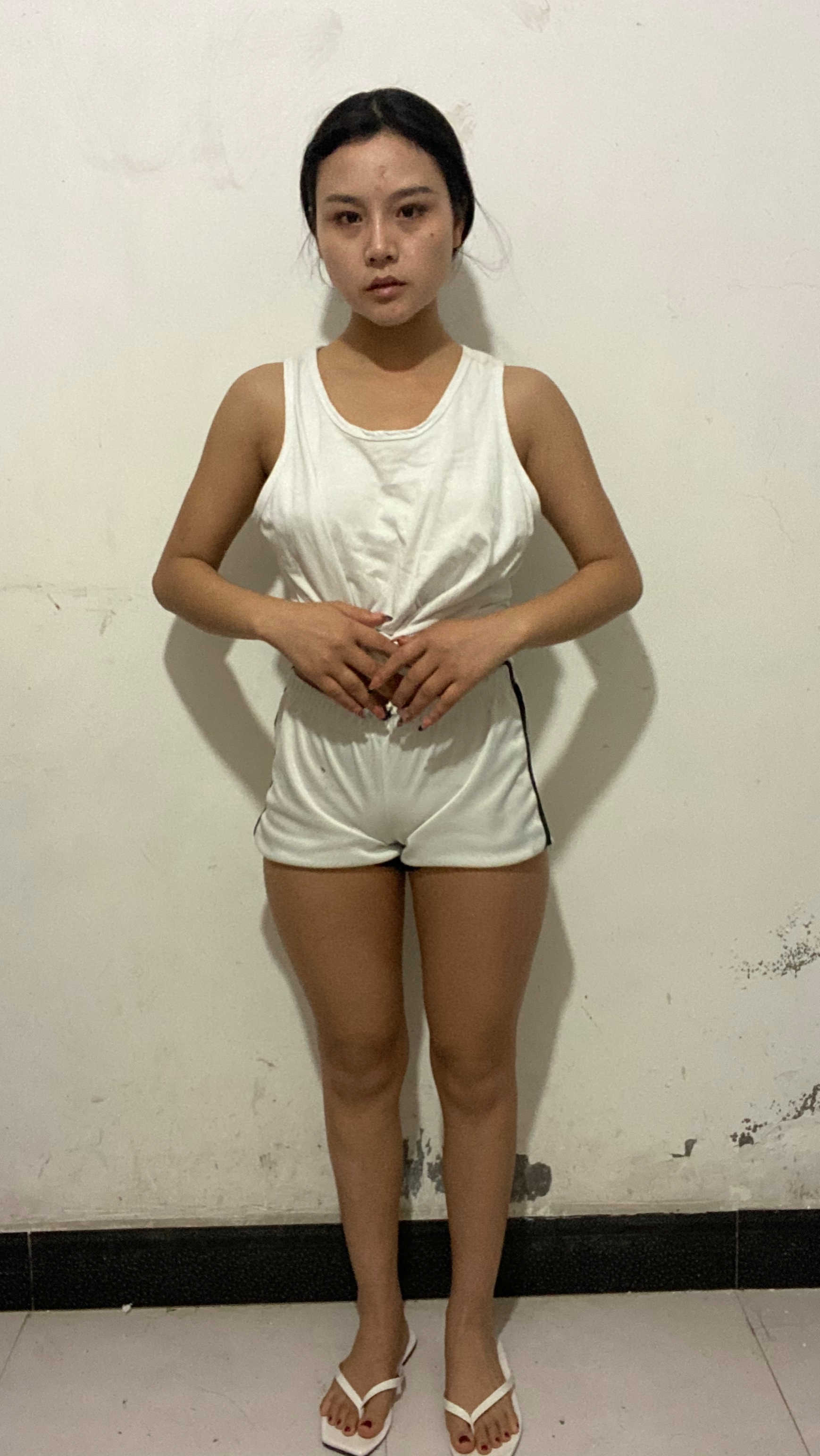 南京美莱吸脂怎么样？附大腿吸脂案例及2021价格表曝光