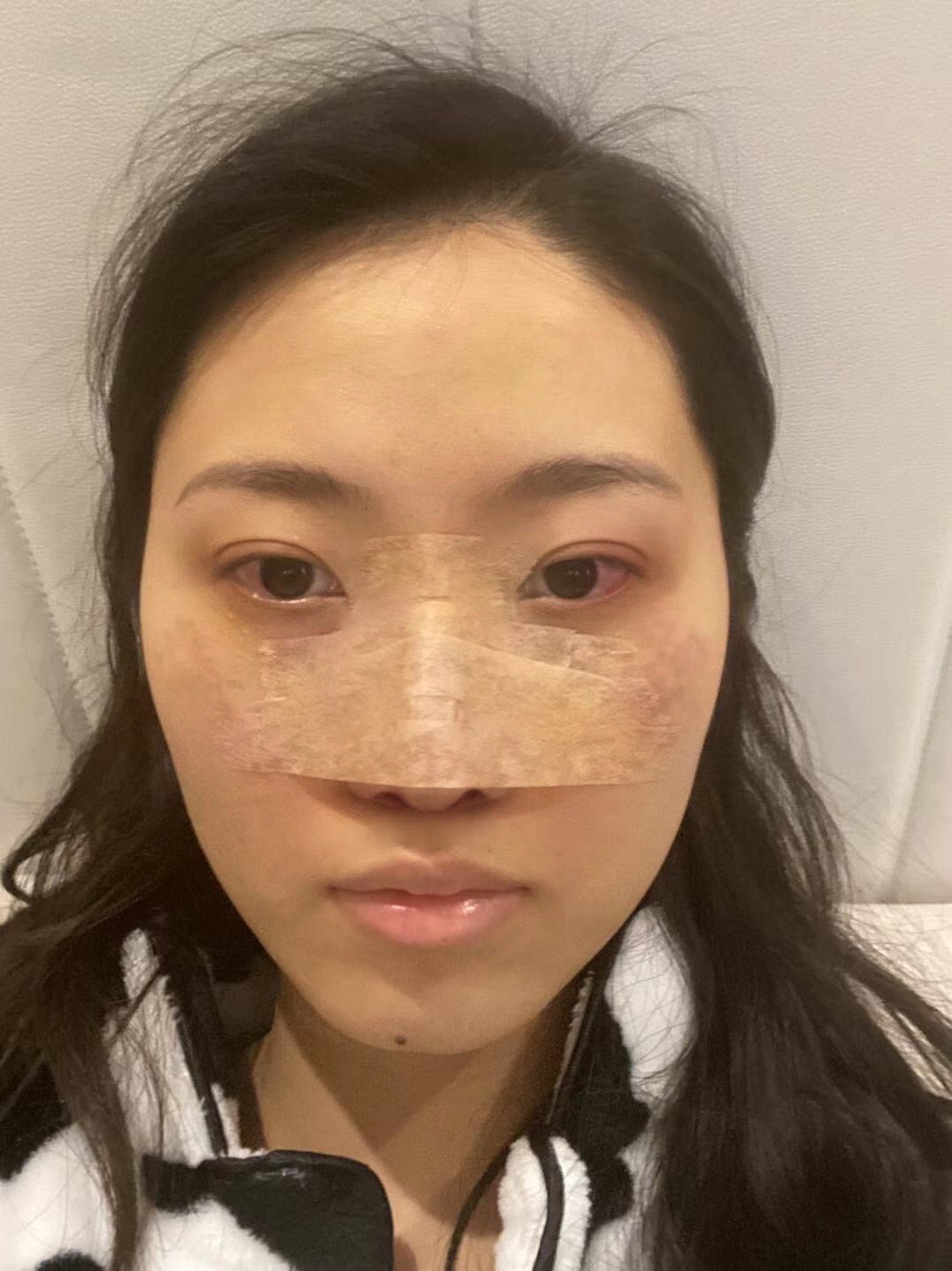 硅胶假体隆鼻案例分享