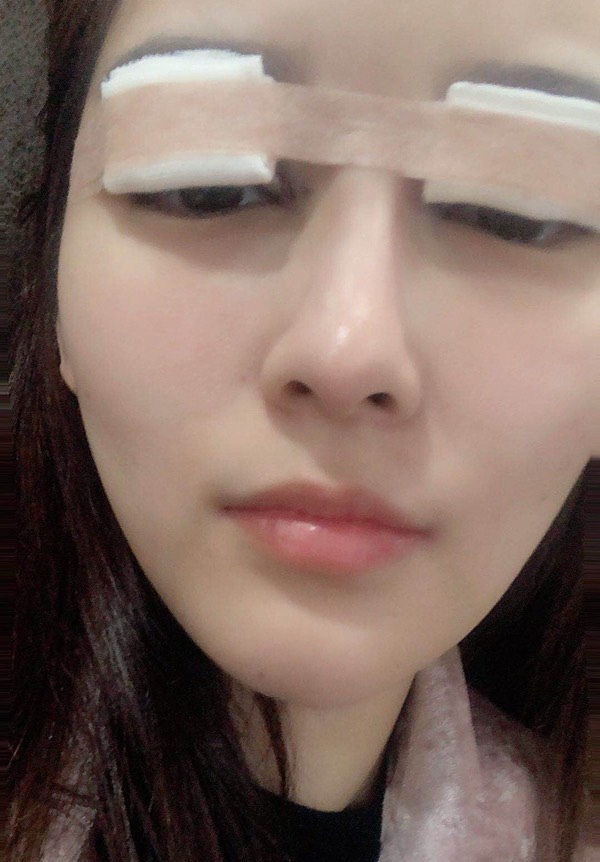 齐尚华院长眼修复做的怎么样？附双眼皮修复案例一览