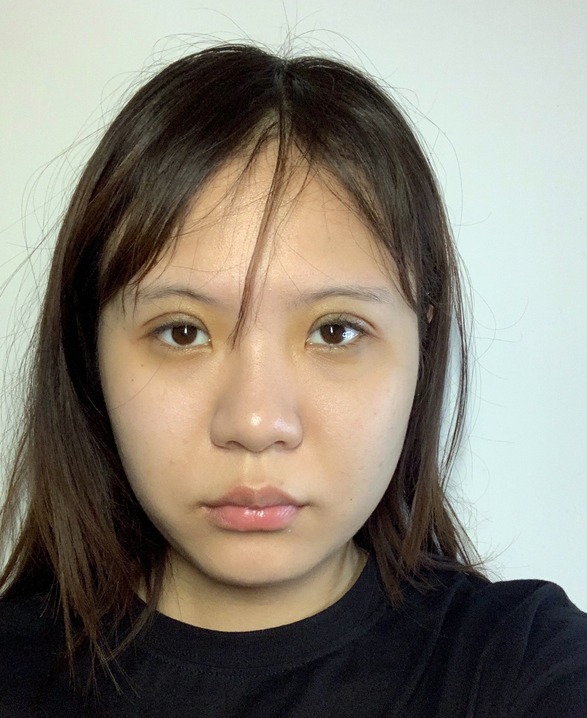 南宁华美整形美容医院价格表2021价格表曝光+双眼皮案例分享