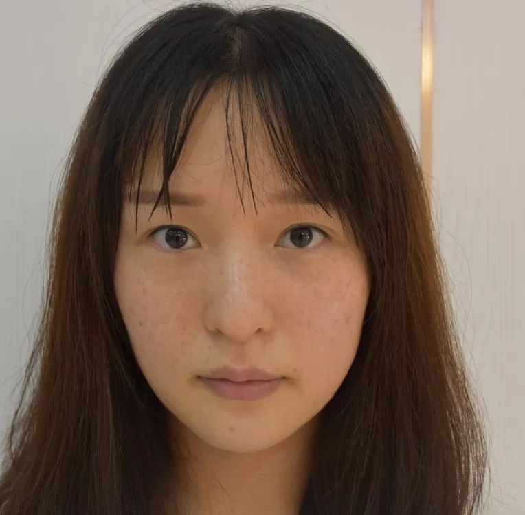 吉大一院整形外科价格表曝光+双眼皮真人案例分享