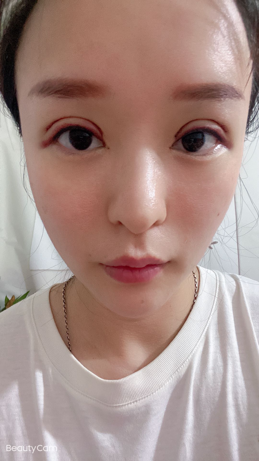 吉大一院整形外科价格表曝光+双眼皮真人案例分享