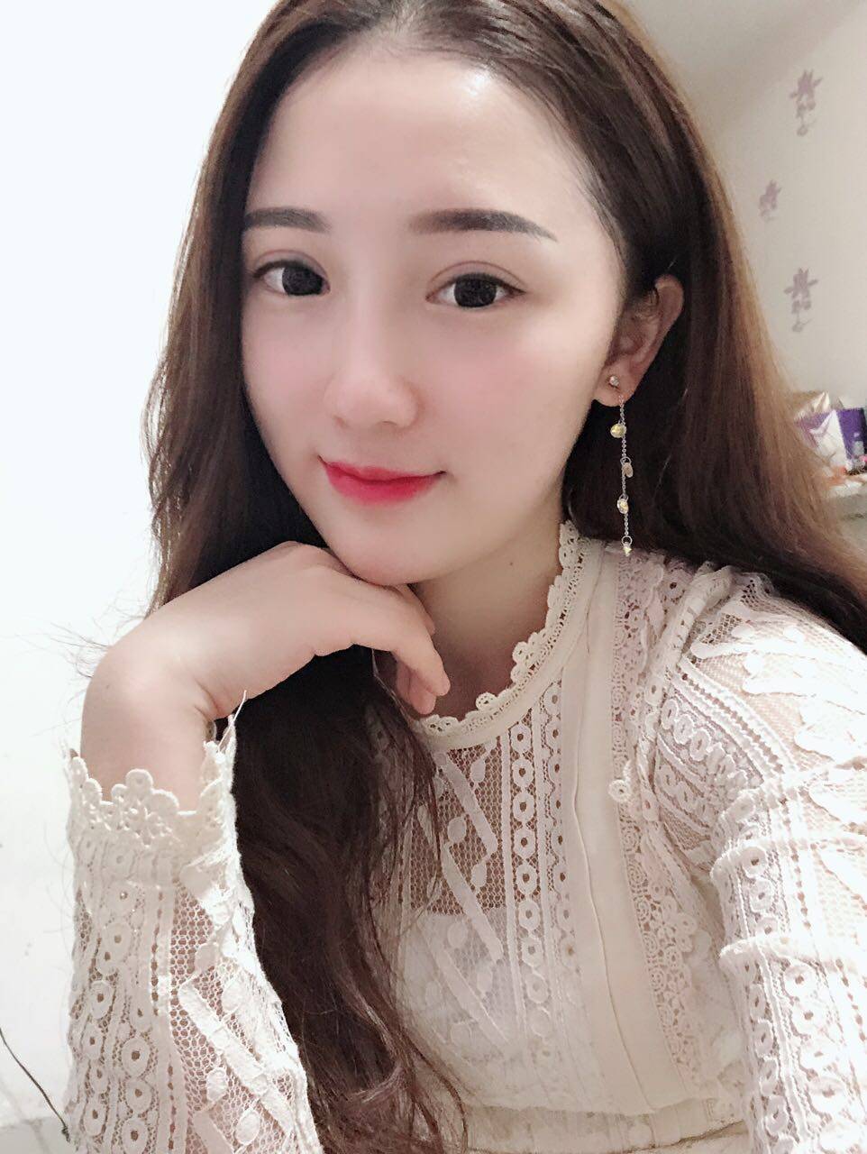 崔永言修复双眼皮案例，附术后效果对比+2021价格表一览