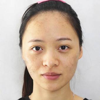珠江医院美容整形激光中心2021价格表公开+激光祛斑案例分享