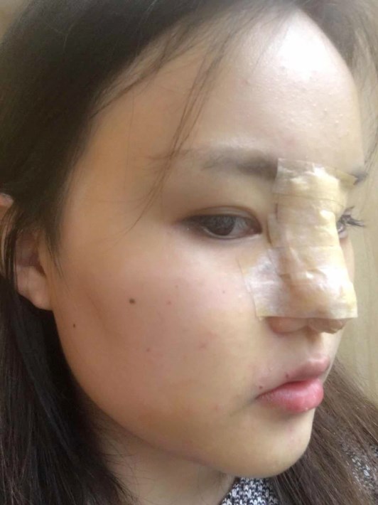 深圳医美汇医疗美容门诊部怎么样？2021价格表曝光+隆鼻术后真人案例分享