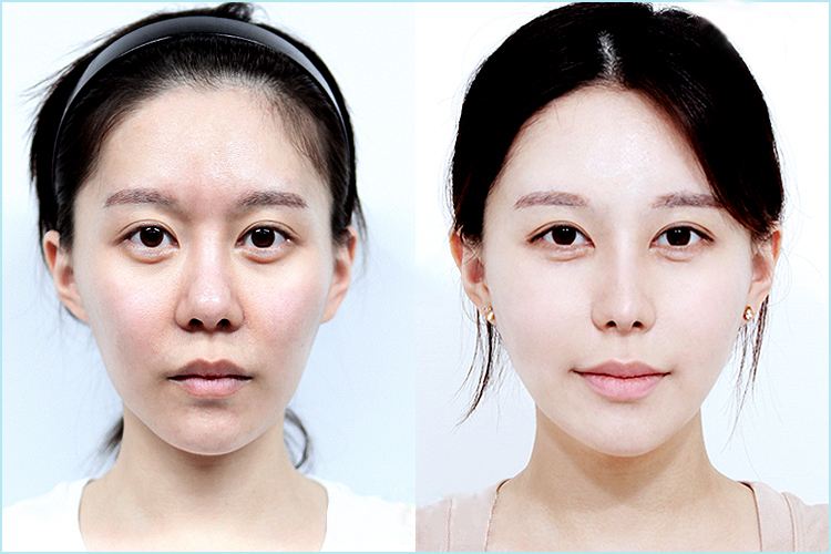 脂肪填充太阳凹大概多少钱 脸部填充脂肪能维持多久