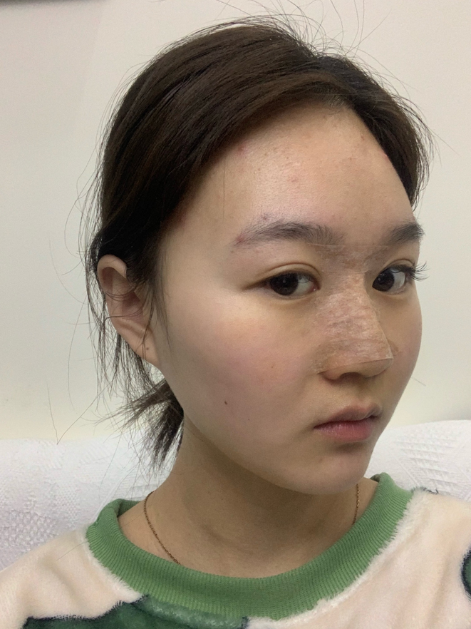 深圳鹏程医院好不好?附医院介绍+隆鼻真人案例分享 深圳鹏程医院好不好?附医院介绍+隆鼻真人案例分享