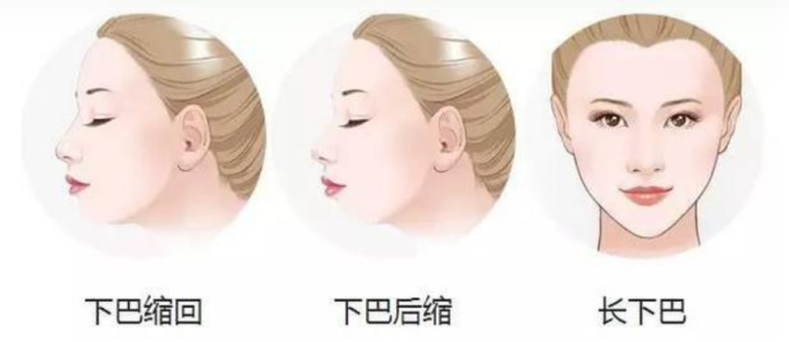 什么人群适合下巴截骨术，需要注意什么