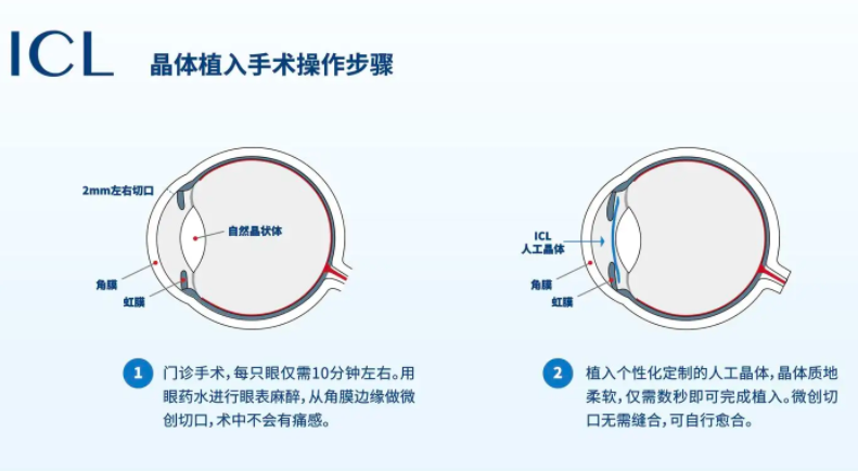 了解什么是晶体植入手术