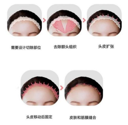 额头缩小术是什么多久恢复自然