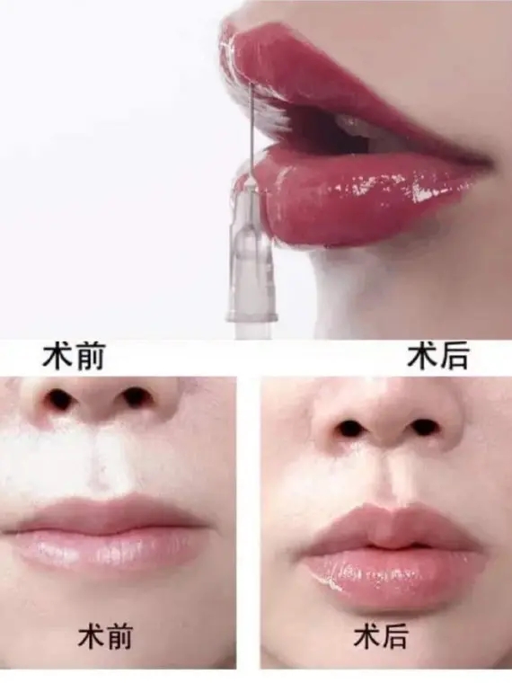 玻尿酸丰唇术前术后注意事项有哪些
