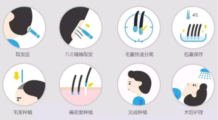 什么是鬓角植发手术术后要怎样护理