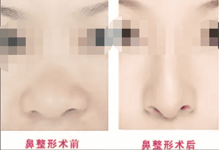 鼻翼肥大整形手术的价格是多少多长时间可以恢复