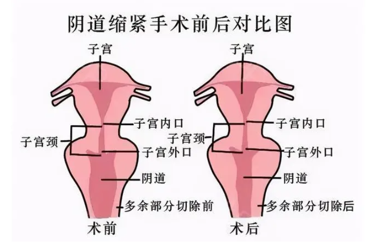 什么是阴道紧缩术呢
