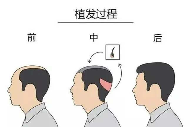 北京薇琳医美植发效果怎么样有哪些医生