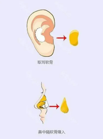 自体耳软骨隆鼻效果如何快来看看吧