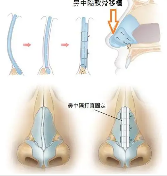 你有经历过鼻骨矫正吗