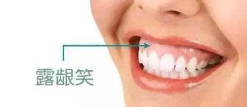 去露龈笑术前术后注意事项都有那些