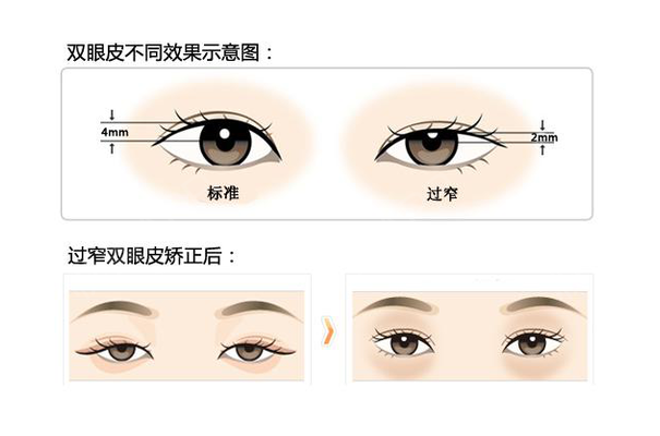郑州市第二附属医院美容整形科怎么样擅长双眼皮手术的医生是谁