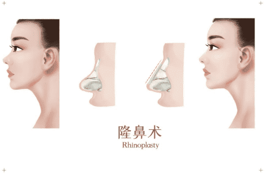 上海喜美医疗整形美容诊所口碑如何这家机构隆鼻技术一流~