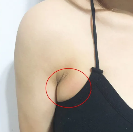 有什么方法可以去副乳